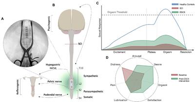 Effect of epidural spinal cord stimulation on female sexual function after spinal cord injury